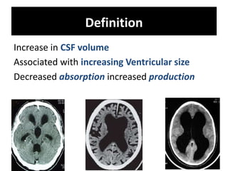 Definition
Increase in CSF volume
Associated with increasing Ventricular size
Decreased absorption increased production
 