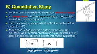 B) Quantitative Study
 We take a midline sagittal T2 image as reference image.
 An Image Plane is drawn perpendicular to the proximal
third of the cerebral aqueduct.
 Then the cursor is placed at its level in the center of the
aqueduct (O).
 Axial phase images are then obtained showing the
aqueduct as a rounded structure (in cross section). (12-16
phase image are obtained alternating systole & diastole)
=Systolic images =Diastolic images
=CSF flow in aqueduct =CSF has in aqueduct
=Is of low S.I =is of high S.I
 