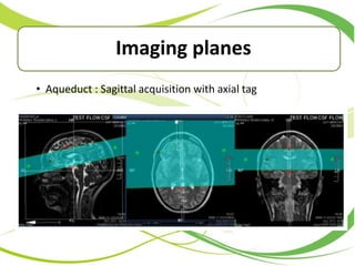• Aqueduct : Sagittal acquisition with axial tag
Imaging planes
 