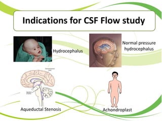 Hydrocephalus
Aqueductal Stenosis
Normal pressure
hydrocephalus
Achondroplast
Indications for CSF Flow study
 