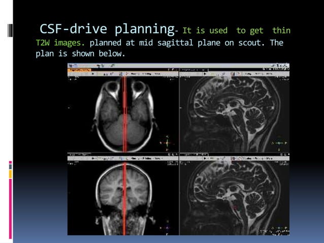 CSF flow study | PPT