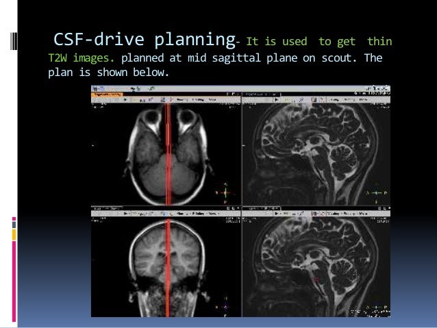CSF flow study