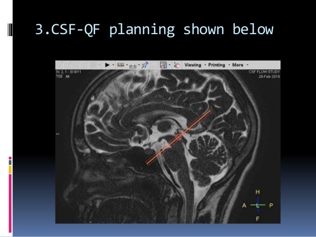 CSF flow study