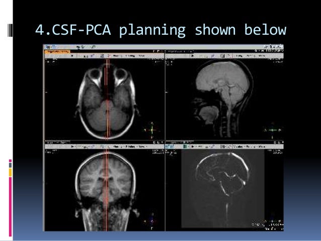 CSF flow study
