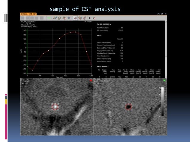 CSF flow study