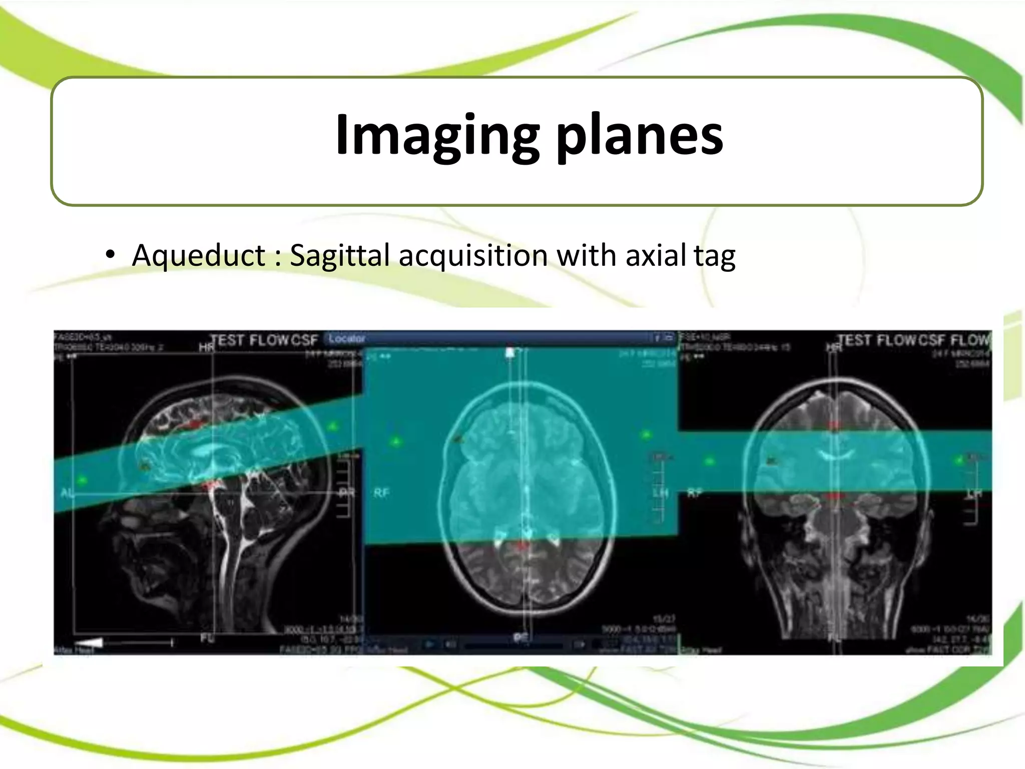 CSF Flow Study In MRI | PPTX