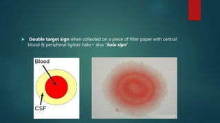  Double target sign when collected on a piece of filter paper with central
blood & peripheral lighter halo – also “halo sign”
 