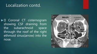 Localization contd.
 Coronal CT cisternogram
showing CSF draining from
the subarachnoid space
through the roof of the right
ethmoid sinus(arrow) into the
nose.
 