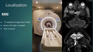 Localization
MRI
 T2 weighted image Site of leak
 Active CSF leak is needed
 Non invasive
 