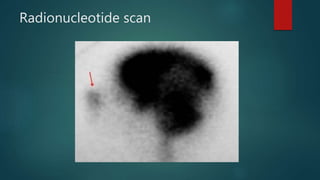 Radionucleotide scan
 
