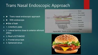 Trans Nasal Endoscopic Approach
  Trans nasal endoscopic approach
  With endoscope
 Site of leak
 1. Cribriform plate
 2. Lateral lamina close to anterior ethmoid
artery
 3. Roof of ETHMOID
 4. Frontal sinus leak
 5. Sphenoid sinus
 