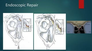 Endoscopic Repair
 