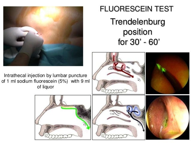 cerebrospinal fluid leak causes cerebrospinal fluid leak causes