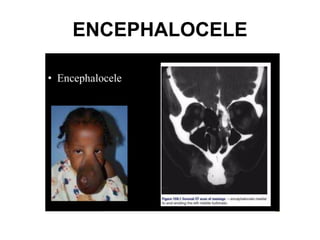 ENCEPHALOCELE
 