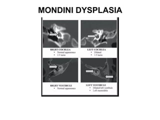 MONDINI DYSPLASIA
 