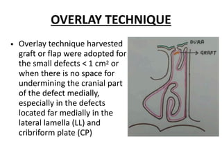 OVERLAY TECHNIQUE
• Overlay technique harvested
graft or flap were adopted for
the small defects < 1 cm2 or
when there is no space for
undermining the cranial part
of the defect medially,
especially in the defects
located far medially in the
lateral lamella (LL) and
cribriform plate (CP)
 
