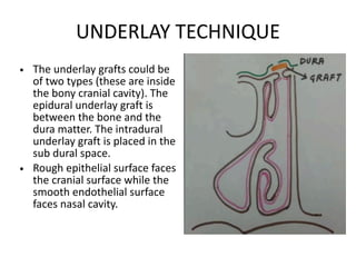 UNDERLAY TECHNIQUE
• The underlay grafts could be
of two types (these are inside
the bony cranial cavity). The
epidural underlay graft is
between the bone and the
dura matter. The intradural
underlay graft is placed in the
sub dural space.
• Rough epithelial surface faces
the cranial surface while the
smooth endothelial surface
faces nasal cavity.
 