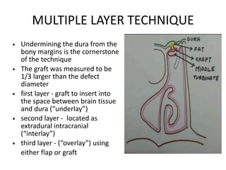 MULTIPLE LAYER TECHNIQUE
• Undermining the dura from the
bony margins is the cornerstone
of the technique
• The graft was measured to be
1/3 larger than the defect
diameter
• first layer - graft to insert into
the space between brain tissue
and dura (“underlay”)
• second layer - located as
extradural intracranial
(“interlay”)
• third layer - (“overlay”) using
either flap or graft
 