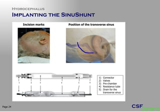 Hydrocephalus Implanting the SinuShunt Page  1) Connector 2) Valves 3) Pre-chamber 4) Resistance tube 5) Drain for the transverse sinus  Incision marks Position of the transverse sinus 