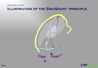 Introduction Illustration of the SinuShunt  principle  Page  