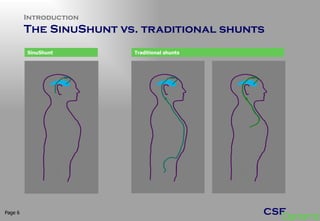 Introduction The SinuShunt vs. traditional shunts Page  SinuShunt Traditional shunts 