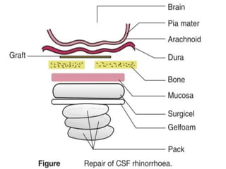 CSF Rhinorrhea | PPTX
