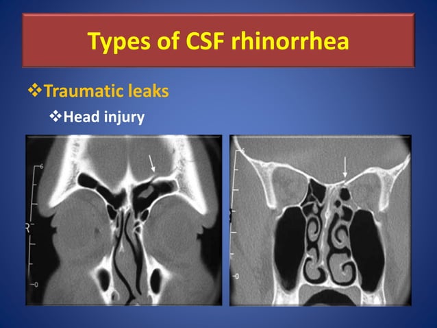 Csf rhinorrhea repair- case report and discussion | PPT