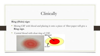 Clinically
Ring (Halo) sign:
• Mixing CSF with blood and placing it onto a piece of filter paper will give a
Ring sign.
• Central blood with clear ring of CSF.
 