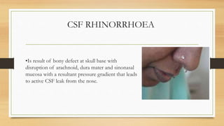 CSF RHINORRHOEA
•Is result of bony defect at skull base with
disruption of arachnoid, dura mater and sinonasal
mucosa with a resultant pressure gradient that leads
to active CSF leak from the nose.
 