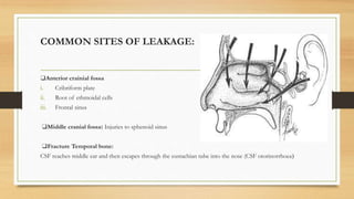 COMMON SITES OF LEAKAGE:
❑Anterior crainial fossa
i. Cribriform plate
ii. Root of ethmoidal cells
iii. Frontal sinus
❑Middle cranial fossa: Injuries to sphenoid sinus
❑Fracture Temporal bone:
CSF reaches middle ear and then escapes through the eustachian tube into the nose (CSF otorinorrhoea)
 