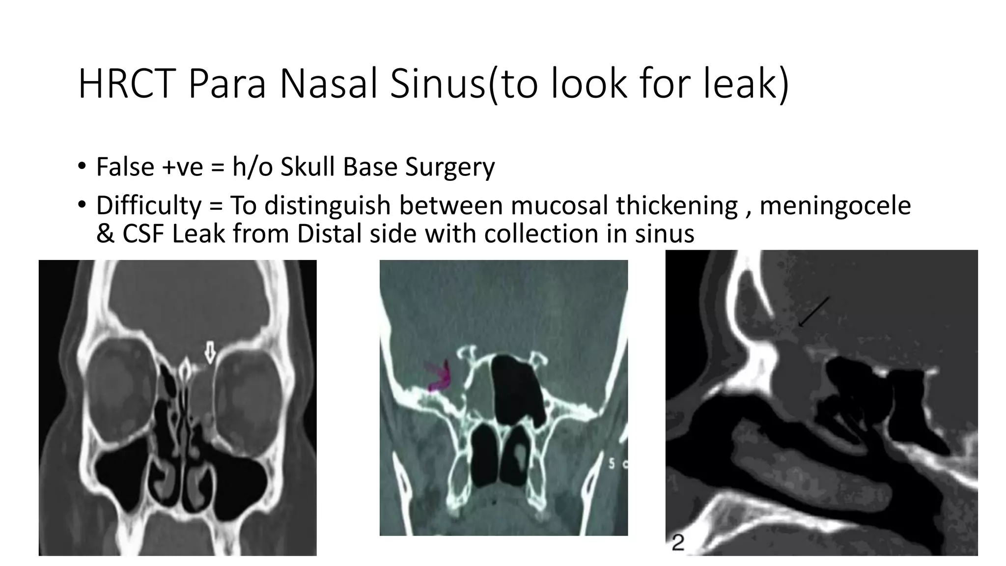 CSF Rhinorrhea | PPTX