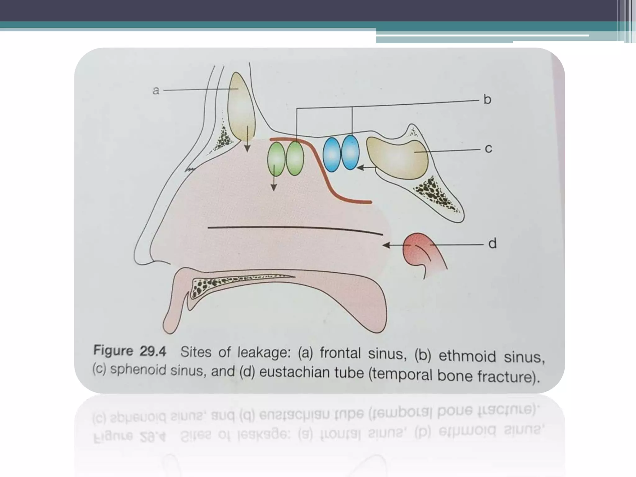 Csf rhinorrhoea | PPTX