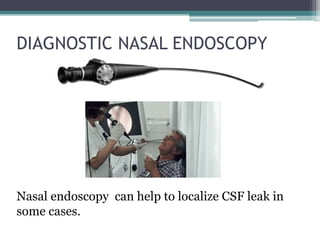 DIAGNOSTIC NASAL ENDOSCOPY
Nasal endoscopy can help to localize CSF leak in
some cases.
 