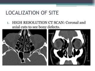 LOCALIZATION OF SITE
1. HIGH RESOLUTION CT SCAN: Coronal and
axial cuts to see bony defects.
 