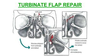 TURBINATE FLAP REPAIR
 