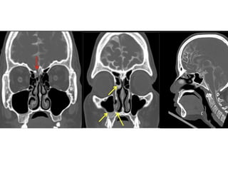 CSF RHINORRHOEA and management of csf rhinorrhea | PPTX