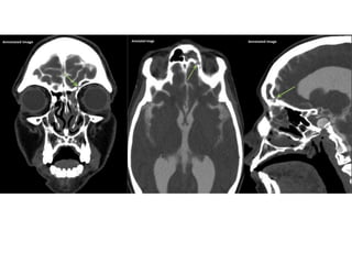 CSF RHINORRHOEA and management of csf rhinorrhea | PPTX