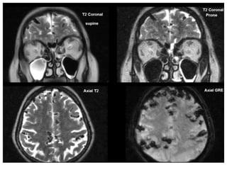 CSF RHINORRHOEA and management of csf rhinorrhea | PPTX