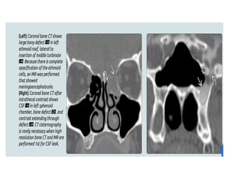 CSF RHINORRHOEA and management of csf rhinorrhea | PPTX