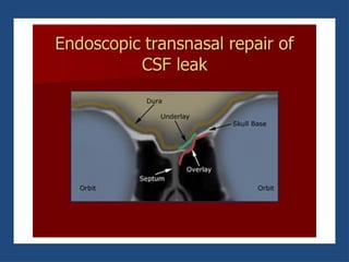 CSF RHINORRHOEA and management of csf rhinorrhea | PPTX