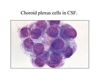 Choroid plexus cells in CSF.
 