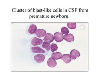 Cluster of blast-like cells in CSF from
premature newborn.
 