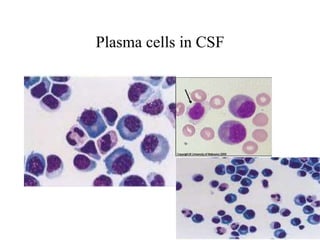 Plasma cells in CSF
 