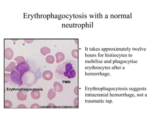 Erythrophagocytosis with a normal
neutrophil
• It takes approximately twelve
hours for histiocytes to
mobilise and phagocytise
erythrocytes after a
hemorrhage.
• Erythrophagocytosis suggests
intracranial hemorrhage, not a
traumatic tap.
 