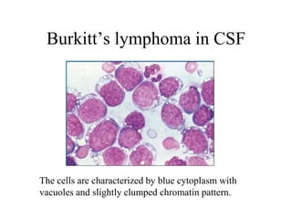 Burkitt’s lymphoma in CSF
The cells are characterized by blue cytoplasm with
vacuoles and slightly clumped chromatin pattern.
 