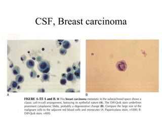 CSF, Breast carcinoma
 