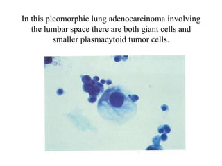 In this pleomorphic lung adenocarcinoma involving
the lumbar space there are both giant cells and
smaller plasmacytoid tumor cells.
 