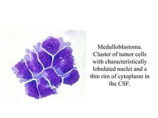Medulloblastoma.
Cluster of tumor cells
with characteristically
lobulated nuclei and a
thin rim of cytoplasm in
the CSF.
 