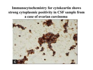 Immunocytochemistry for cytokeartin shows
strong cytoplasmic positivity in CSF sample from
a case of ovarian carcinoma
 