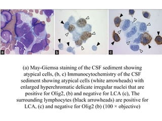 (a) May-Giemsa staining of the CSF sediment showing
atypical cells, (b, c) Immunocytochemistry of the CSF
sediment showing atypical cells (white arrowheads) with
enlarged hyperchromatic delicate irregular nuclei that are
positive for Olig2, (b) and negative for LCA (c), The
surrounding lymphocytes (black arrowheads) are positive for
LCA, (c) and negative for Olig2 (b) (100 × objective)
 